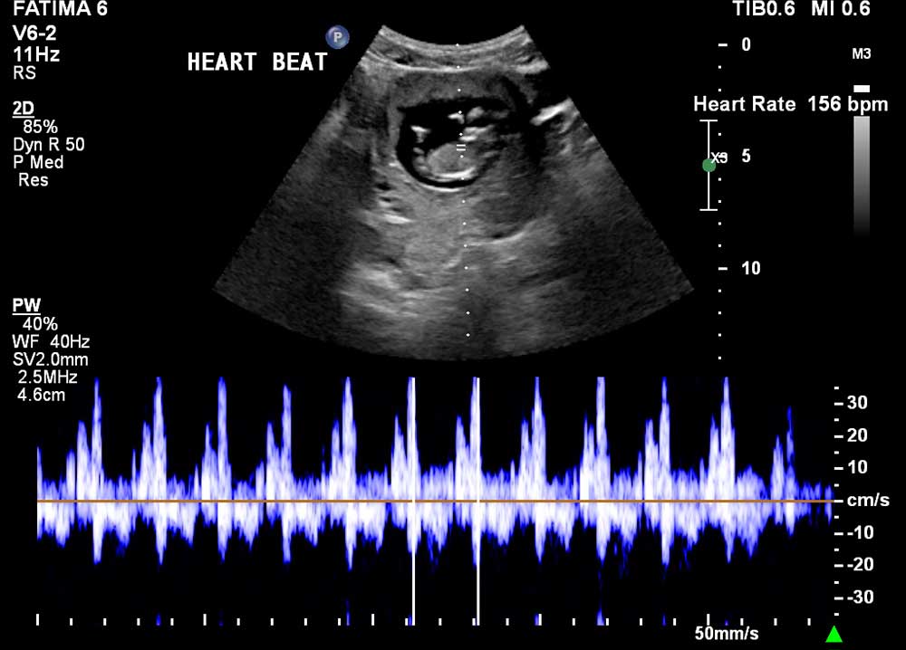 Early Pregnancy Scan Fatima Gani