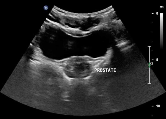 Prostate Gland Scan - Ultrasound Scan