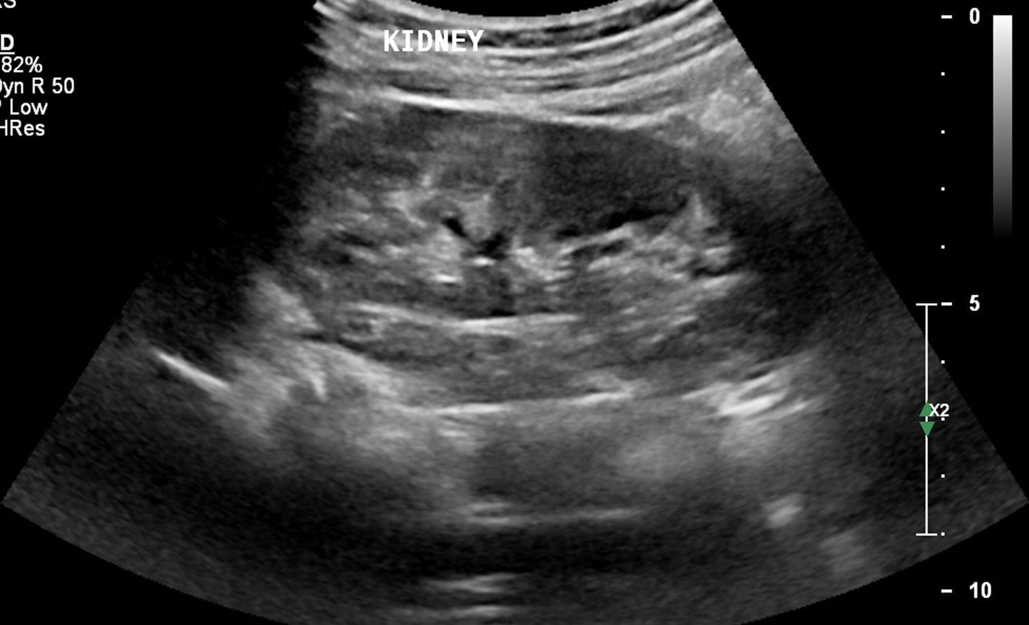 Abdominal Ultrasound Scan - Ultrasound Scan